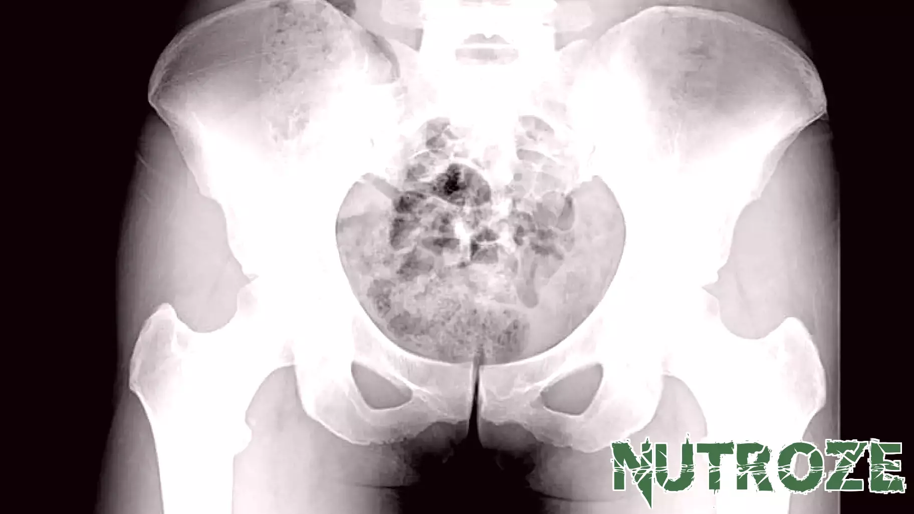 Bone Density Measures Give Insight Into Overall Health Risk in Older Women