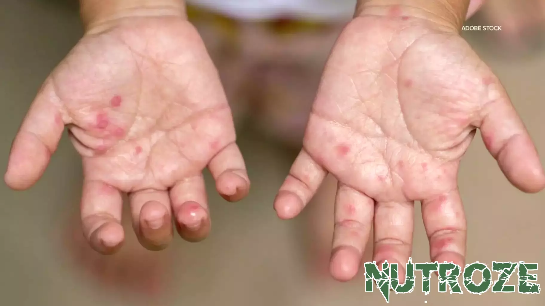 First Cases of Measles Confirmed in Tarrant County
