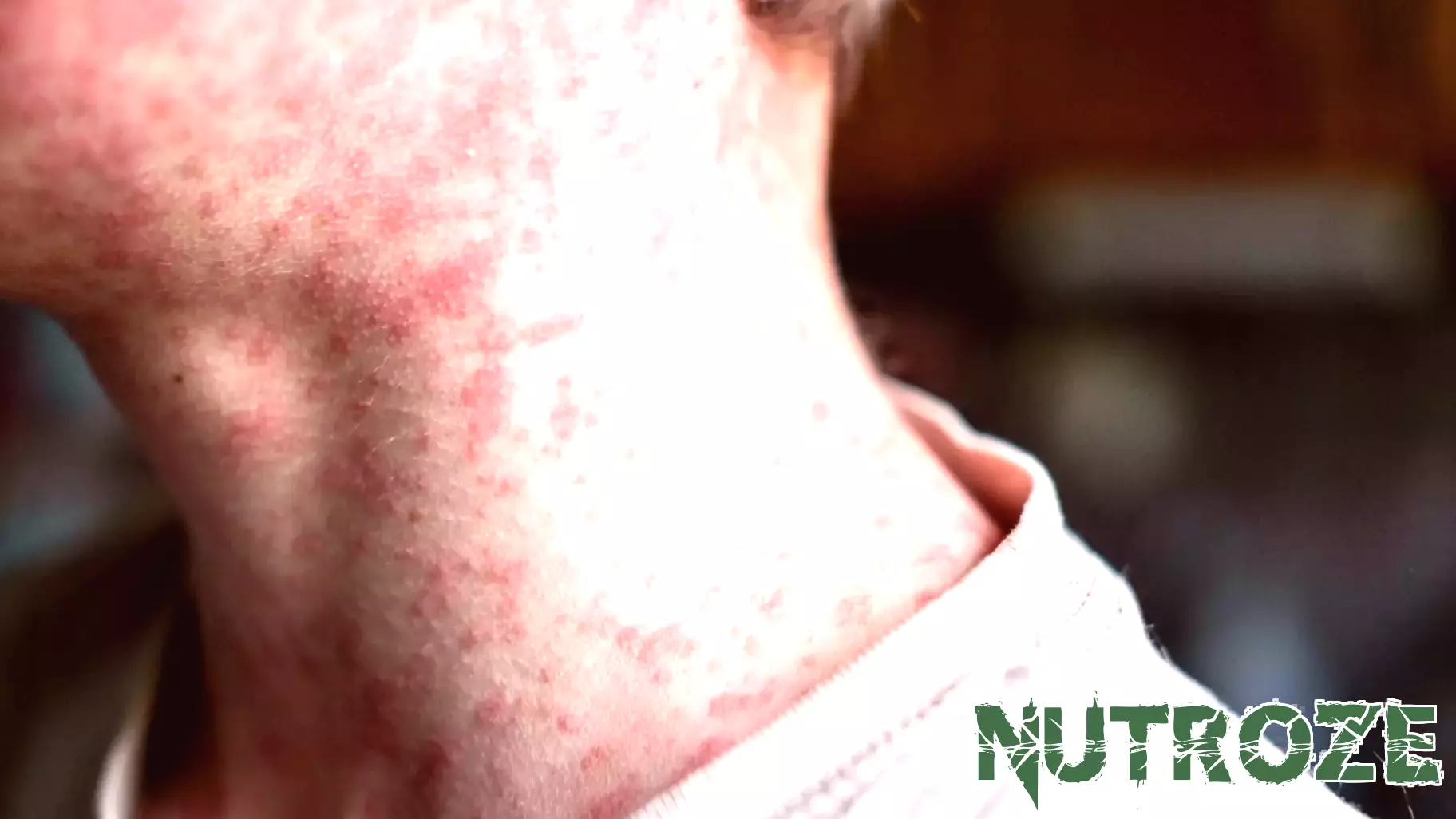 Measles' resurgence in the US is a grim sign of what's coming