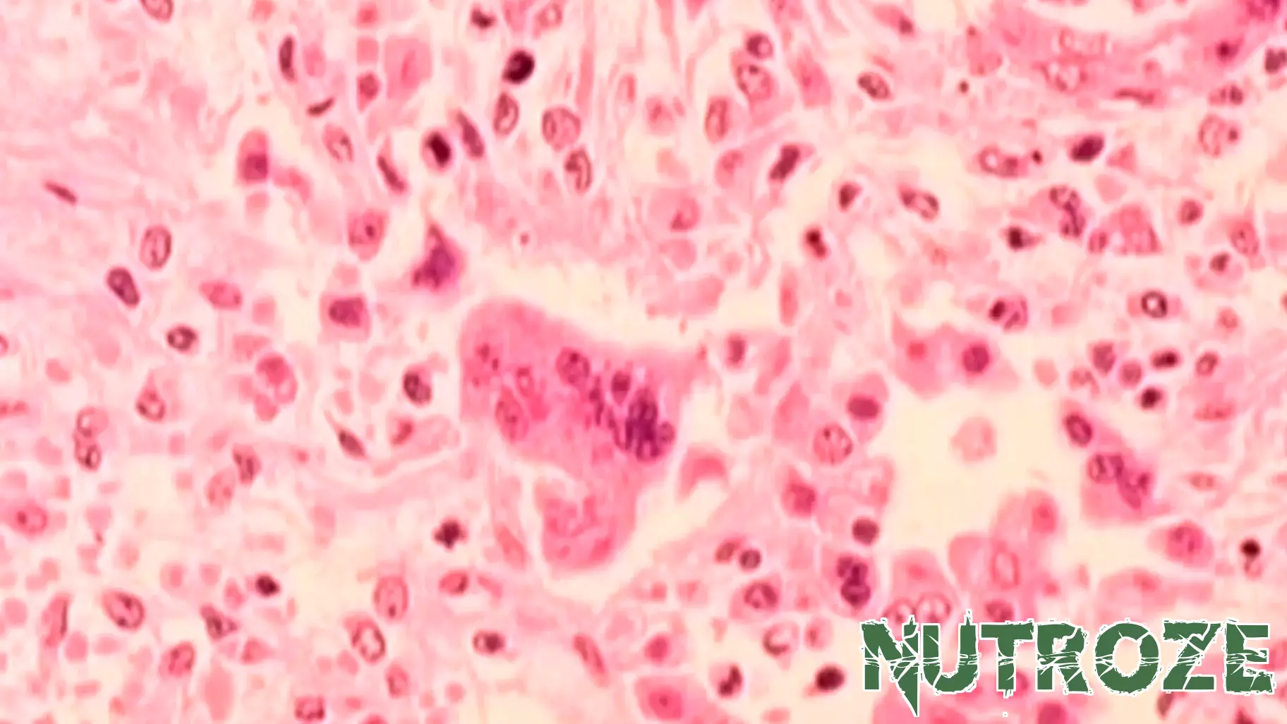 Warning Issued for Potential Measles Exposure in Massachusetts