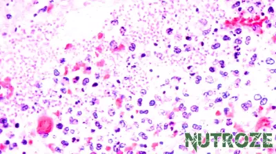 First Death from Pneumonic Plague in Arizona Since 2007