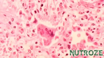 Warning Issued for Potential Measles Exposure in Massachusetts